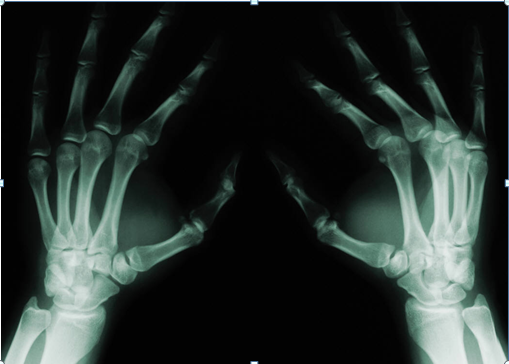 Finger Length Ratios Related to Child Aggression and Attention Problems