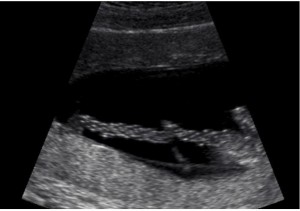 Ultrasound