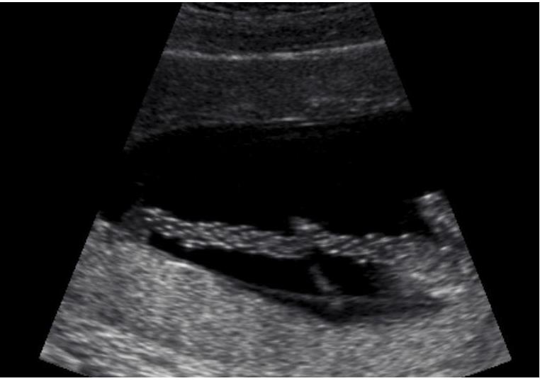 Ultrasounds and Maternal-Fetal Attachment